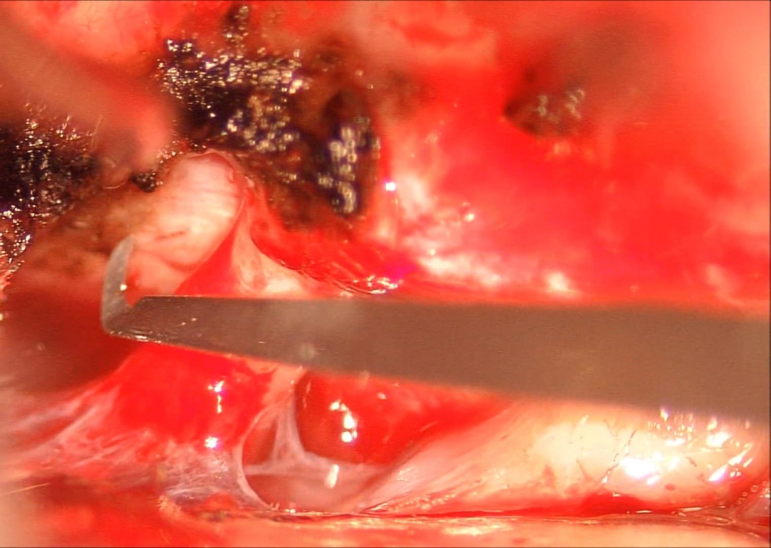 Pterional for Carotid-Cavernous Fistula