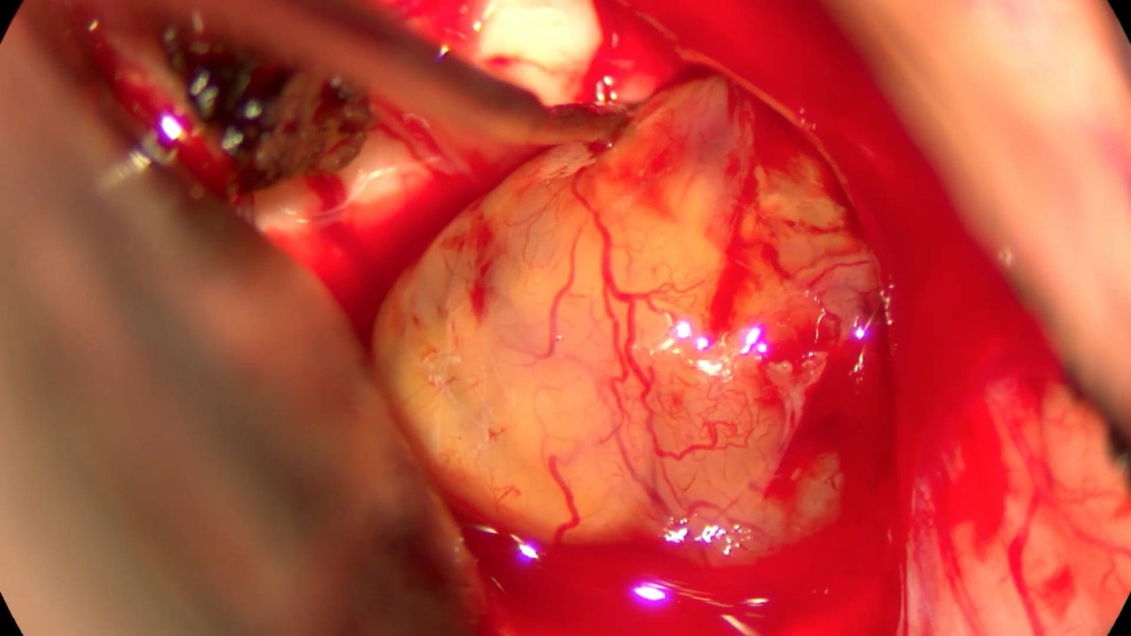 Anterior Transpetrosal Craniotomy for Trochlear Nerve Schwannoma