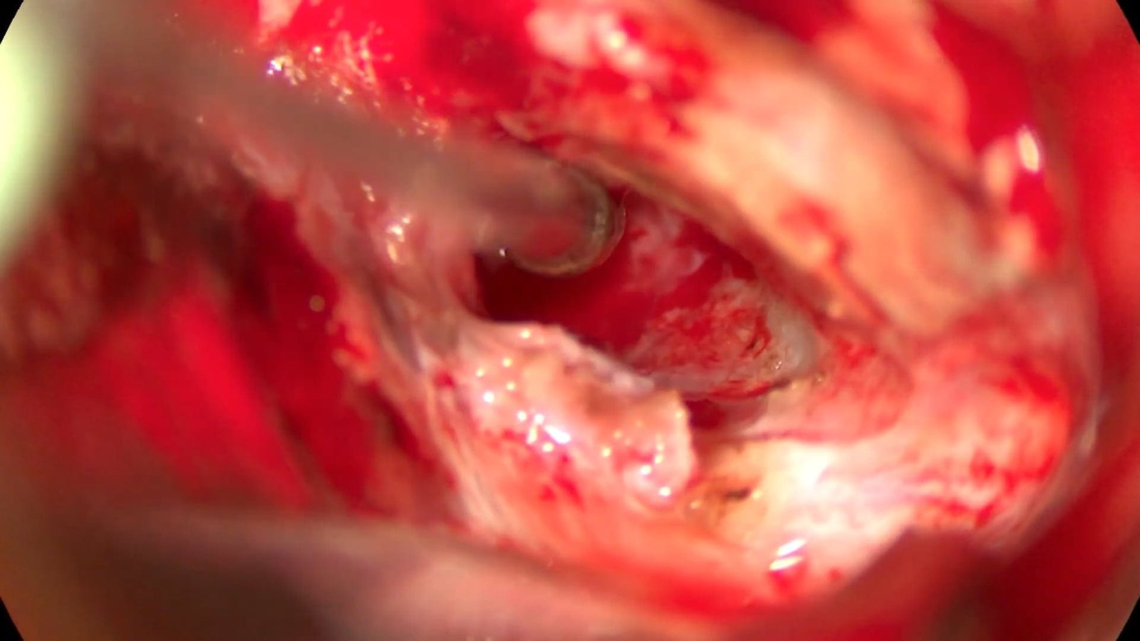 Meckel’s Cave Chondrosarcoma