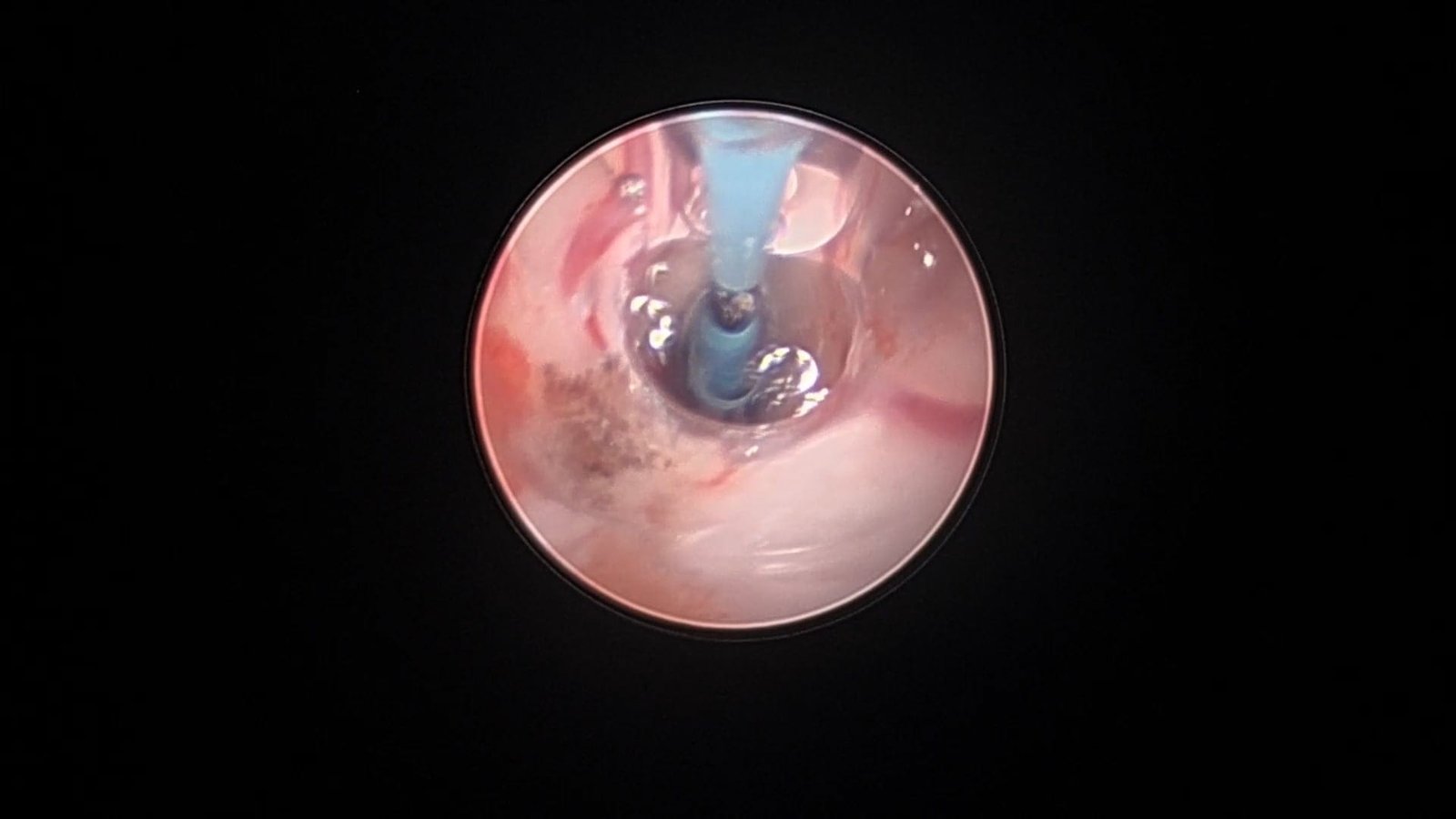 Endoscopic Third Ventriculostomy