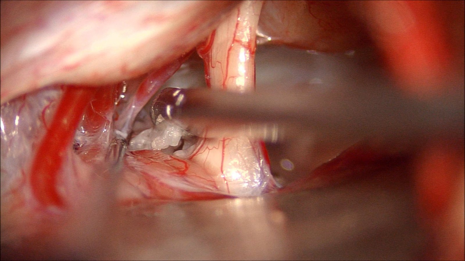 Suboccipital Craniotomy for CPA Epidermoid Cyst