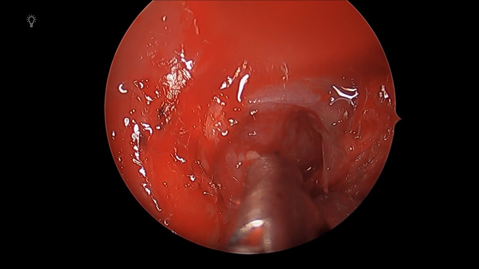 Endoscopic Endonasal Pituitary Adenoma