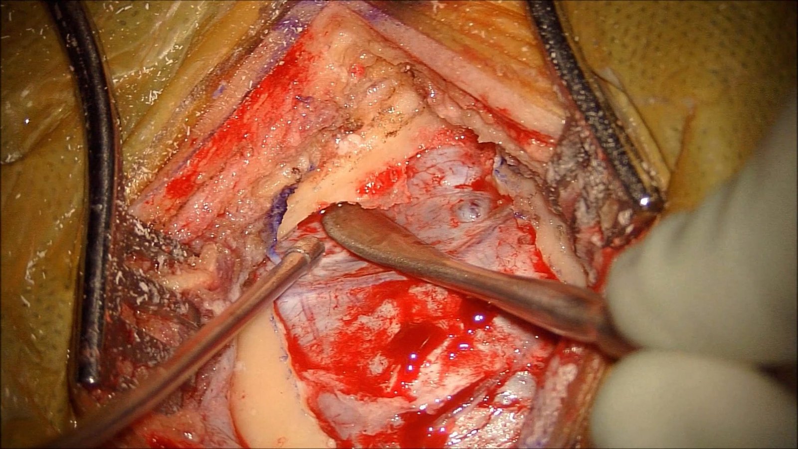 Left Petrous Apex Meningioma
