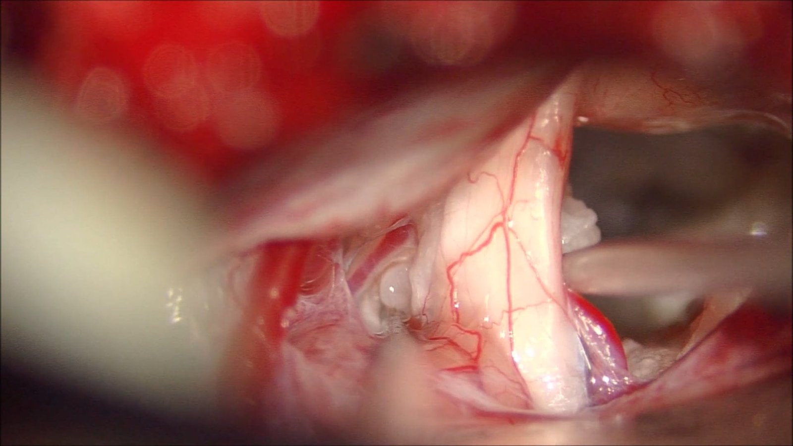 Suboccipital CP Angle Epidermoid Cyst