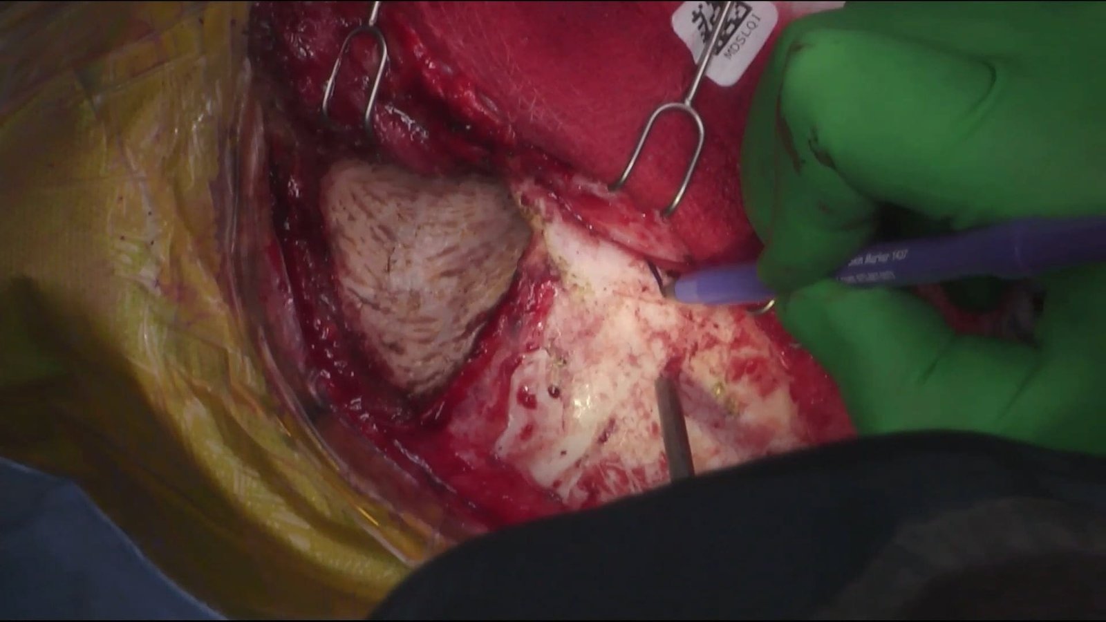 Orbitozygomatic Craniotomy for  Cavernous Sinus Pituitary Adenoma
