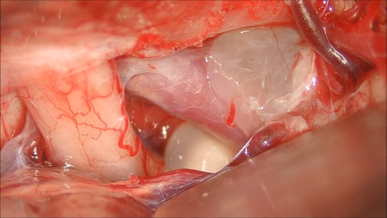 Pterional Craniotomy for Suprasellar Dermoid