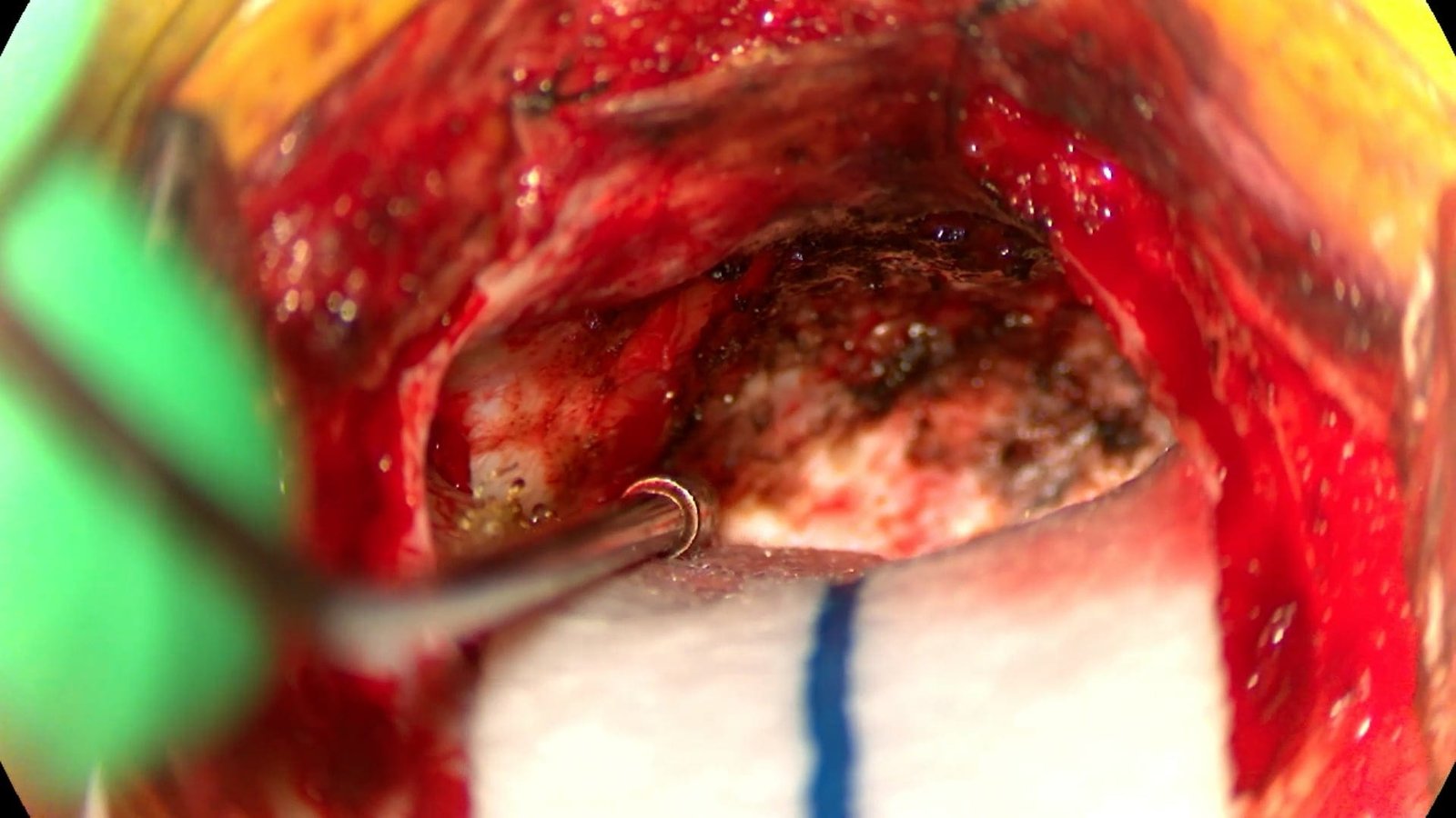 Middle Fossa Approach for Meningioma Resection