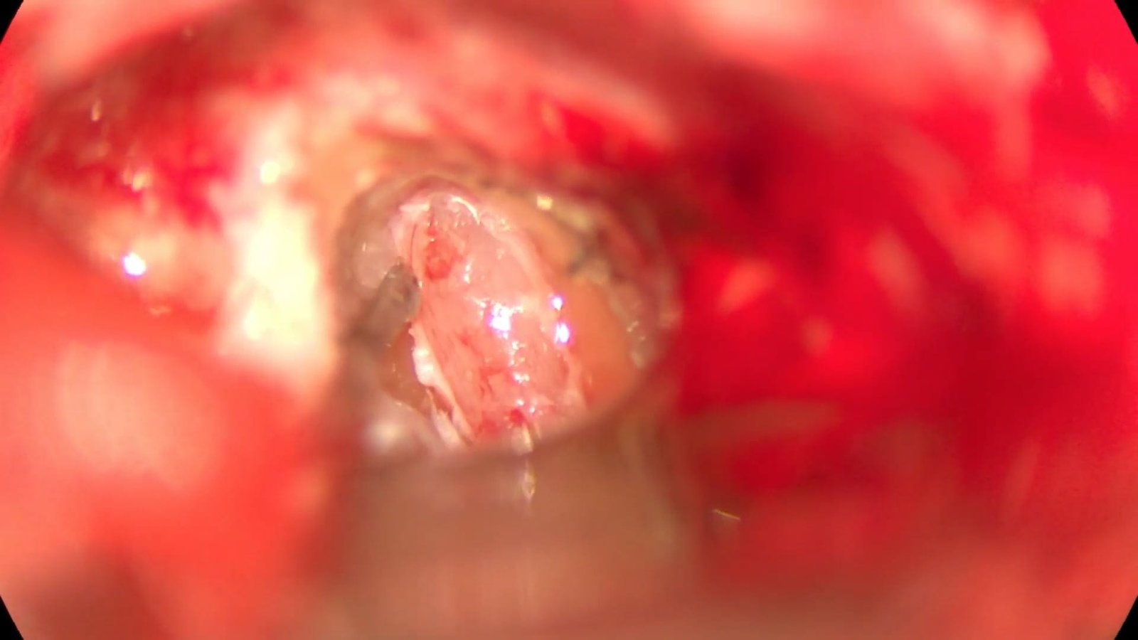 Suboccipital Craniotomy for Vestibular Schwannoma