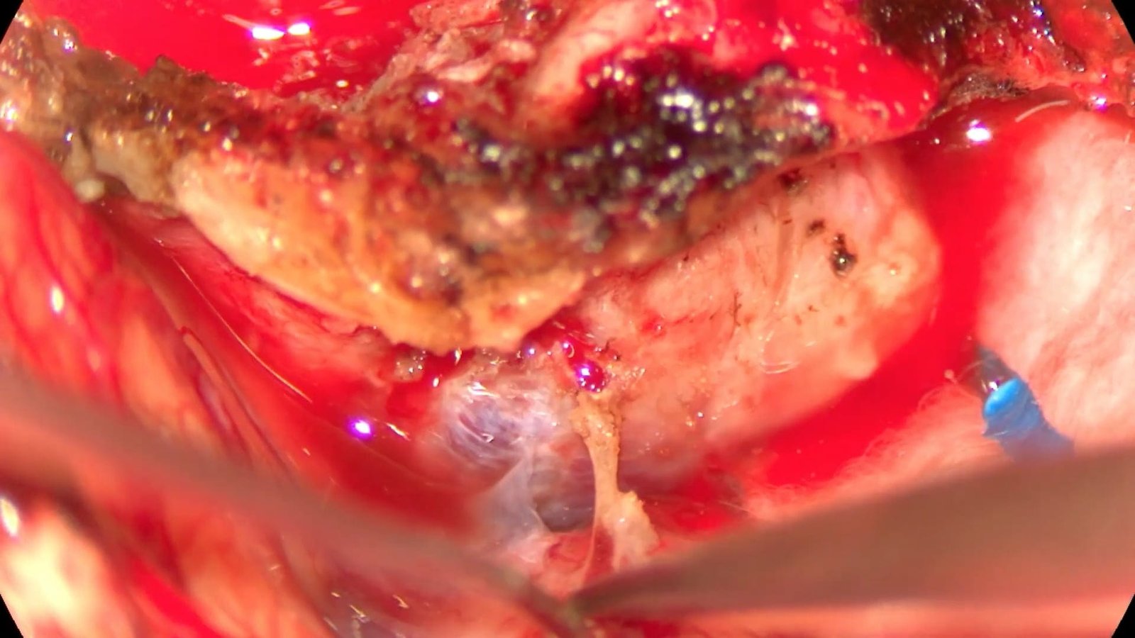 Pterional for a Sphenoid Wing Meningioma