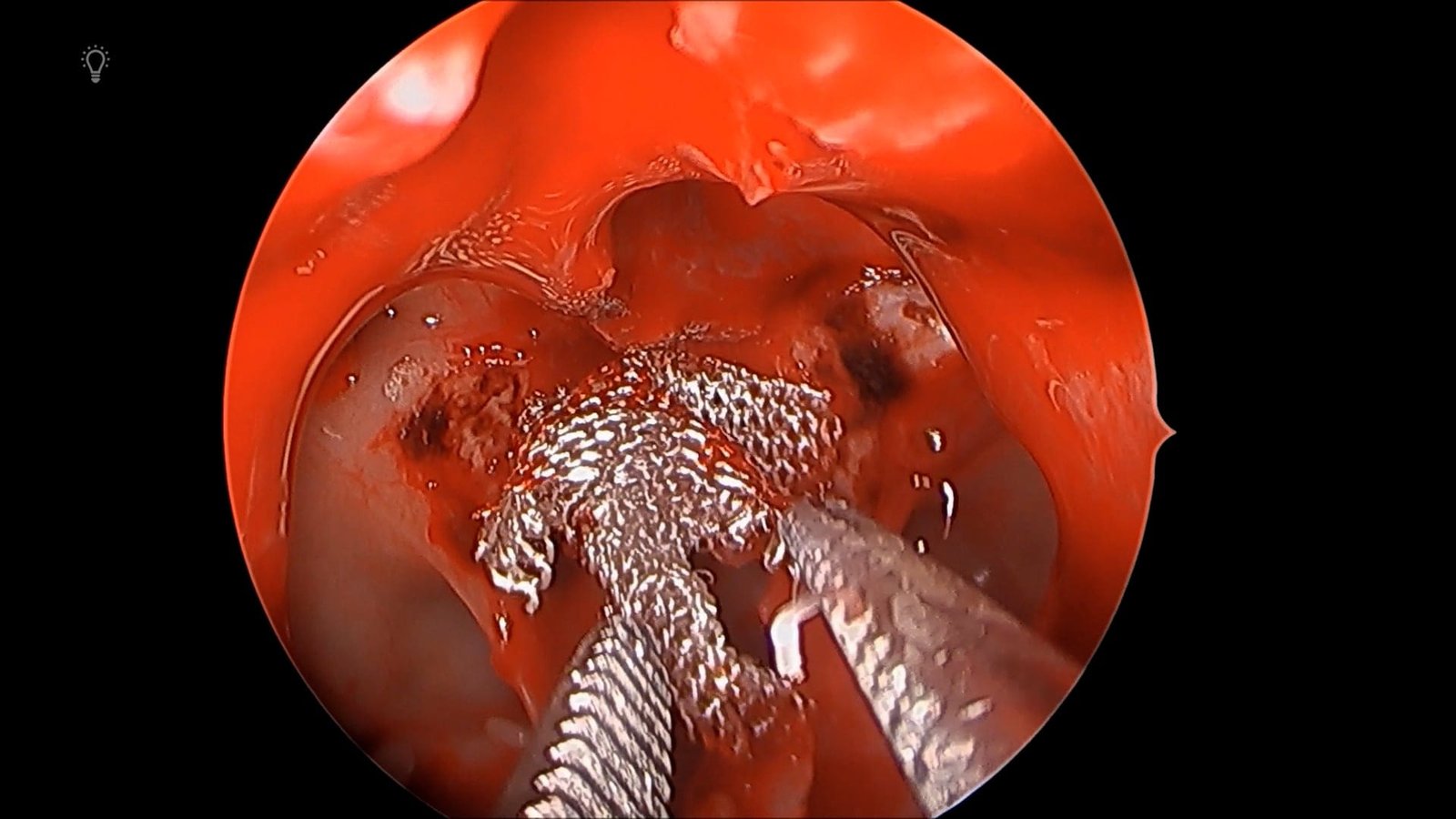 EER of Pituitary Mass
