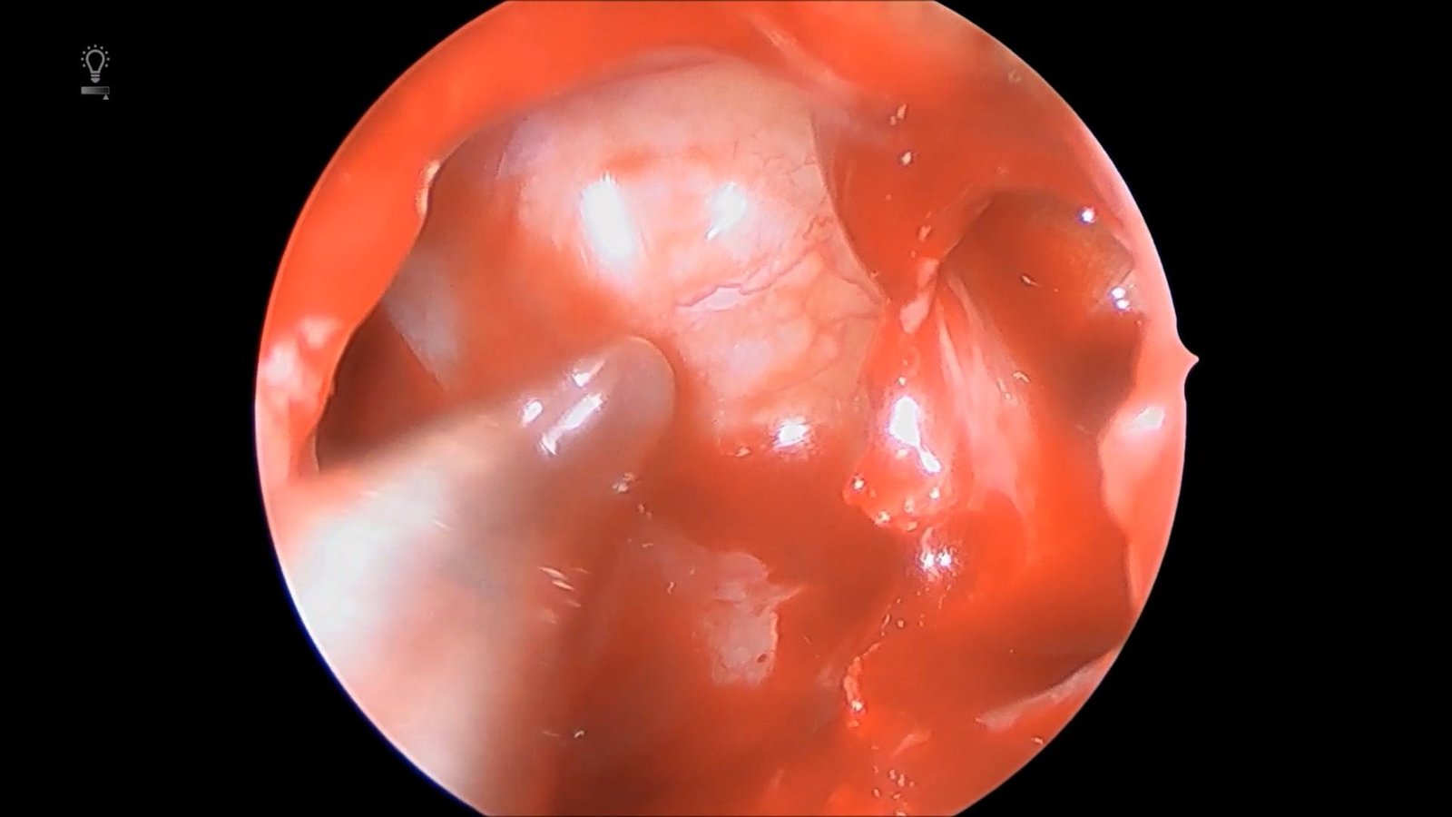 Endoscopic Endonasal Transphenoidal of Pituitary Adenoma