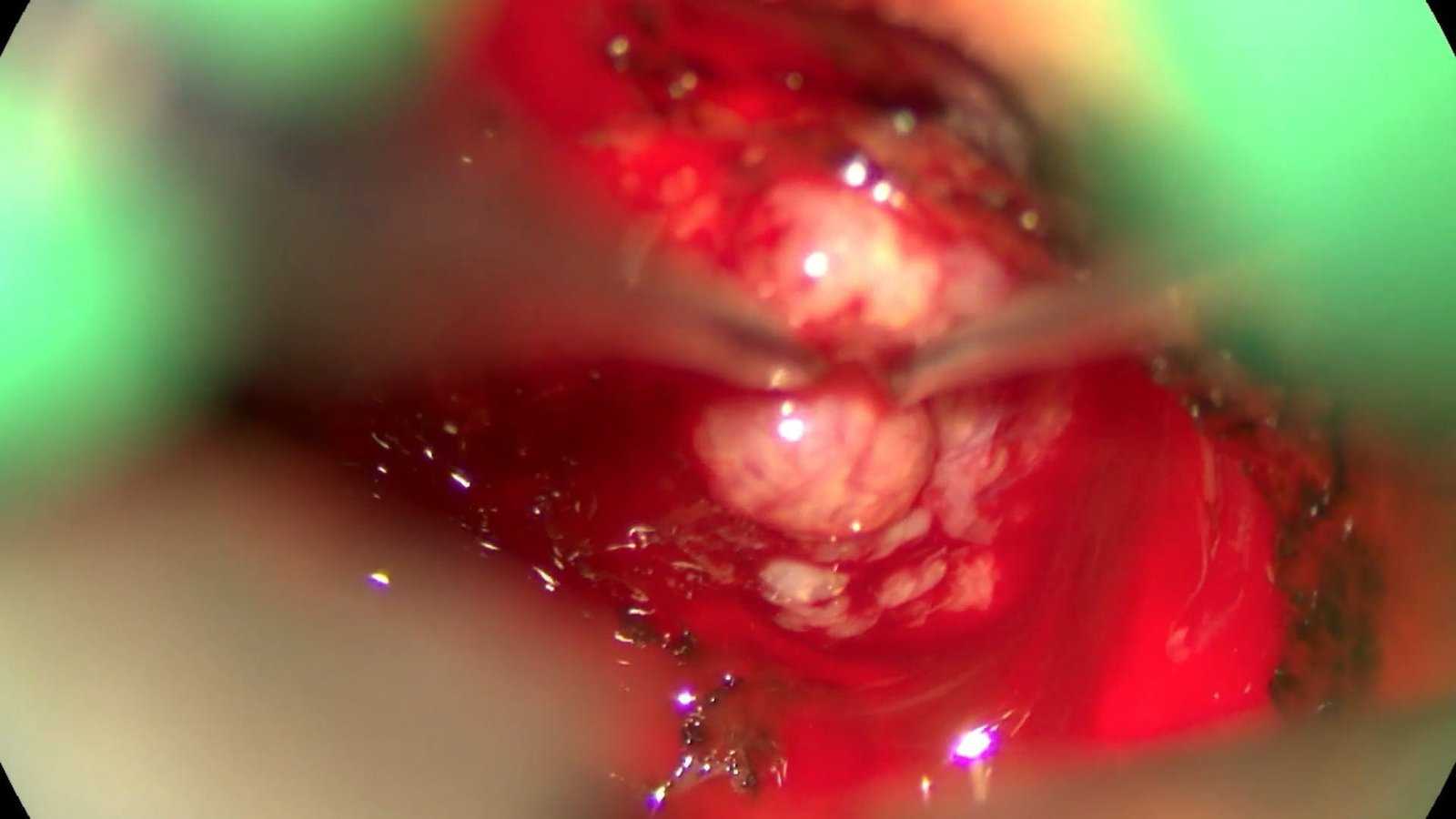 Transpetrosal Approach to Petroclival Tentorial Meningioma